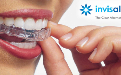 Como funciona o Invisalign